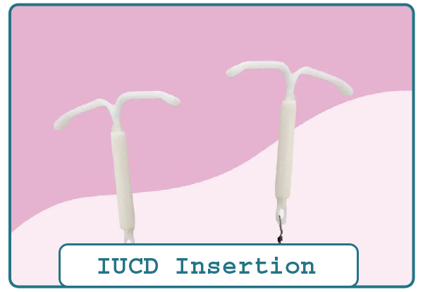 IUD Insertion