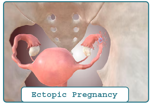 Ectopic Pregnancy