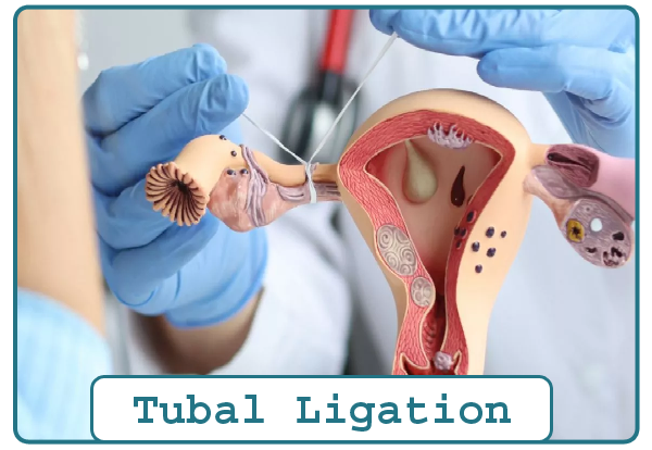 Tubal Ligation