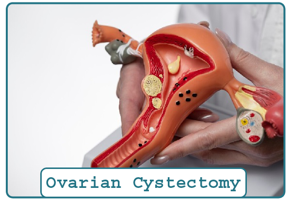 Ovarian Cystectomy